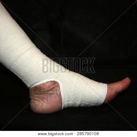 Leg. Varicose, Veins. Phlebeurysm. Thrombophlebitis. Elastic Bandage.