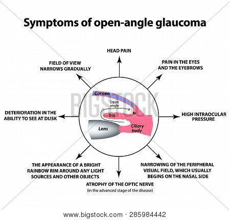 Symptoms Of Open-angle Glaucoma. World Glaucoma Day. The Anatomical Structure Of The Eye. Infographi