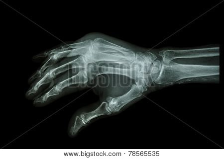 Fracture At 3Rd And 4Th Metacarpal Bone