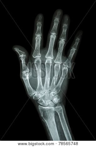 Multiple Fracture At Index,little Finger,metacarpal Bone