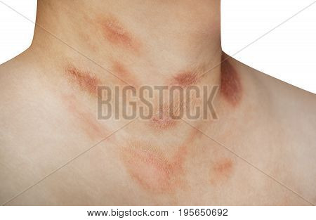 One person with Pityriasis rosea disease on the chest and neck on an isolated background