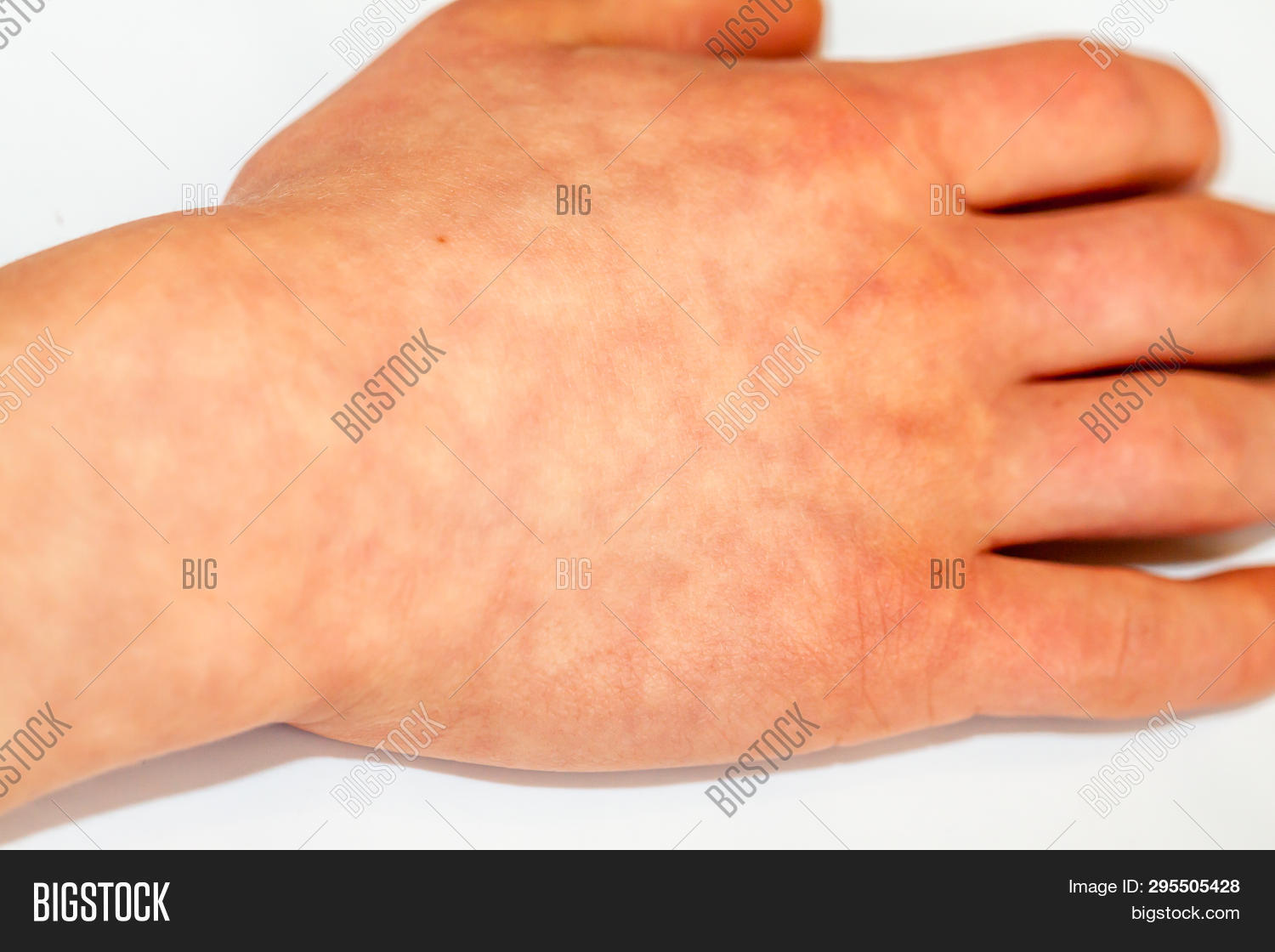 Erythema Ab Igne Heat Image & Photo (Free Trial) Bigstock