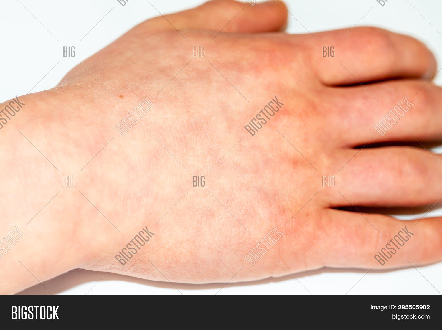 Erythema Ab Igne Heat Image & Photo (Free Trial) Bigstock
