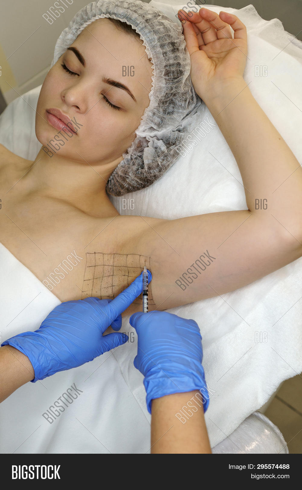 Ботокс в подмышки форум. Ботокс в подмышки форум. Гипергидроз подмышки диспорт. Ботокс в подмышки форум. Гипергидроз подмышек ботулинотерапия.