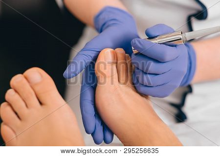 Laser Treatment On Toenail, Fungal Infection On The Toenails