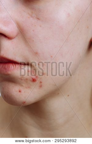 Young Women With Problematic Skin And Pimples On Her Face. Feamle Showing Her Acne. Skincare, Beauty