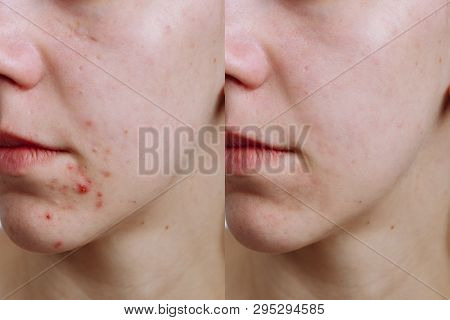 Young Woman Before And After Acne Treatment, Closeup. Skin Care Concept
