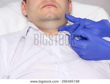 Elimination Of The Second Chin In A Young Caucasian Man With The Help Of Cannoli. Introduction Of Sp