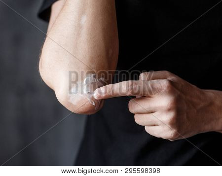 Vitiligo Close-up On Hands And Elbows. Man Smears Pigment Cream. Cares For The Skin. Vitiligi Treatm