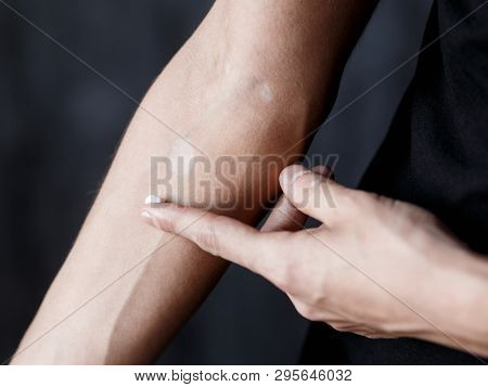 Vitiligo Close-up On Hands And Elbows. Man Smears Pigment Cream. Cares For The Skin. Vitiligi Treatm