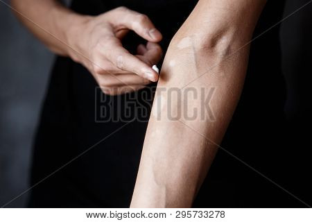 Vitiligo Close-up On Hands And Elbows. Man Smears Pigment Cream. Cares For The Skin. Vitiligi Treatm