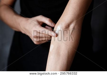 Vitiligo Close-up On Hands And Elbows. Man Smears Pigment Cream. Cares For The Skin. Vitiligi Treatm