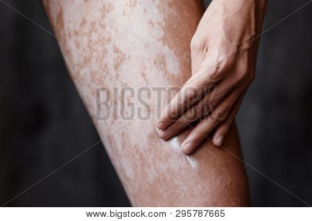 Vitiligo Close-up On The Legs Of A Man. A Young Guy Cares For The Skin, Smears The Skin With Pigment
