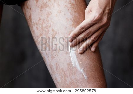 Vitiligo Close-up On The Legs Of A Man. A Young Guy Cares For The Skin, Smears The Skin With Pigment