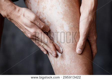 Vitiligo Close-up On The Legs Of A Man. A Young Guy Cares For The Skin, Smears The Skin With Pigment