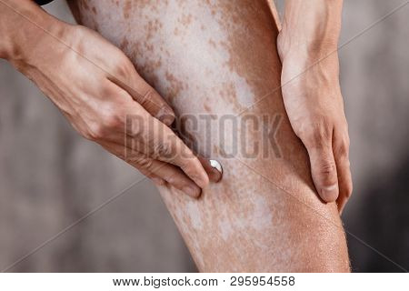 Vitiligo Close-up On The Legs Of A Man. A Young Guy Cares For The Skin, Smears The Skin With Pigment