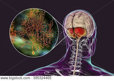 Human Brain With Highlighted Cerebellum And Close-up View Of Purkinje Neurons, One Of The Commonest 