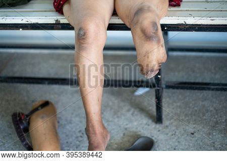 Below Knee Amputee Patient With Muscle Training For Prosthesis