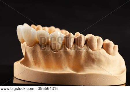 Close-up View Of Dental Layout Of Upper Veneers Of Teeth Prothesis