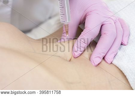 Lipolytic Injections Are Placed In The Stomach. Female Hands In Pink Gloves Inject A Young Woman Int