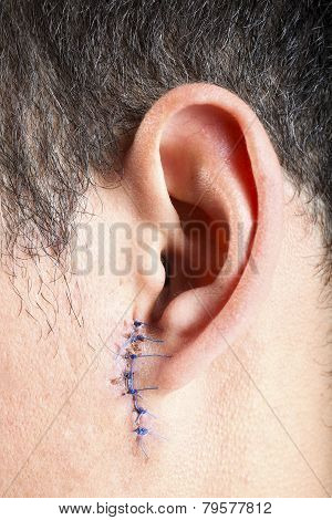 Stitches On Man Ear