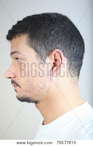Stitches On Man Face
