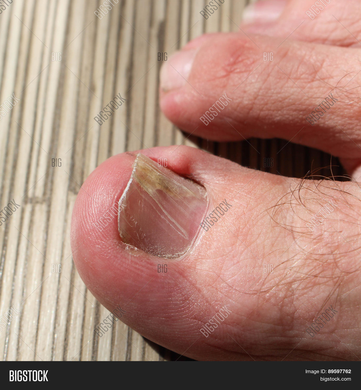 Damaged Toenail Image & Photo (Free Trial) Bigstock