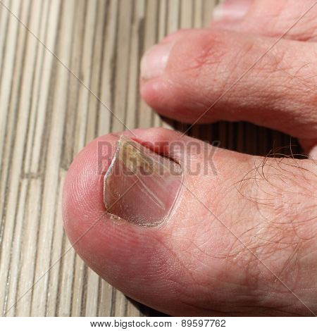 Damaged toenail