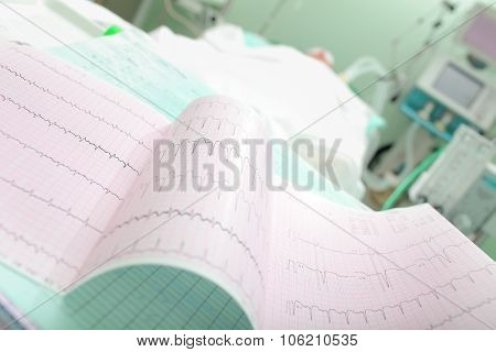 Cardiogram Of A Patient With Acute Cardiovascular Failure