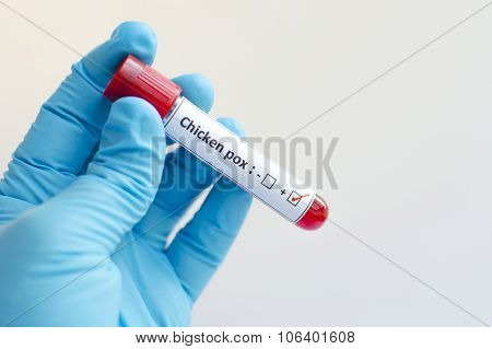 Chicken pox blood sample