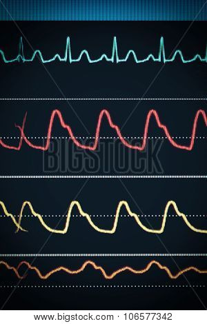 Ecg Chart On The Monitor Around The Clock Surveillance