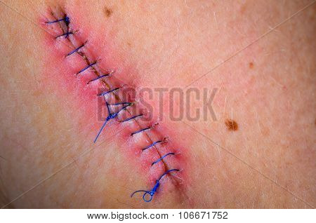 Stitched Up Wound After Mole Removal Surgery.
