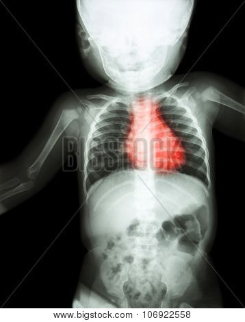 Film X-ray Whole Child 's Body With Heart Disease ( Rheumatic Heart Disease , Valvular Heart Disease