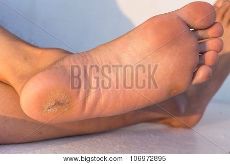 foot corn