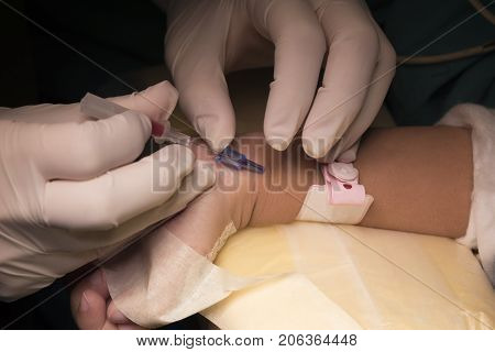 Doctor Withdrawing The Needle For Arterial  Line