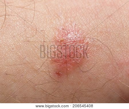 Ringworm of the skin. macro . Photos in the studio