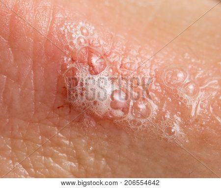 hydrogen peroxide on human skin. macro . Photos in the studio