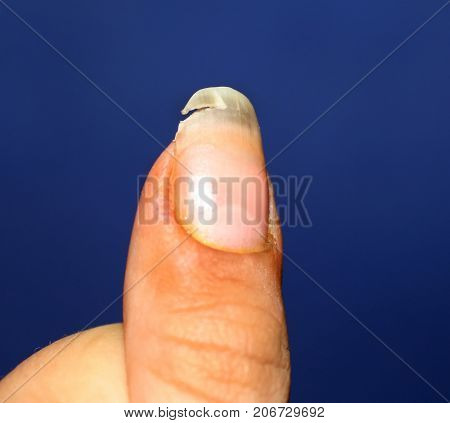 A broken nail. Lack of vitamins and calcium in the body