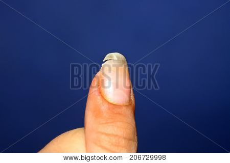 A broken nail. Lack of vitamins and calcium in the body