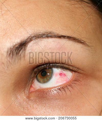 Inflamed eye. Red vascular mesh in the eye.