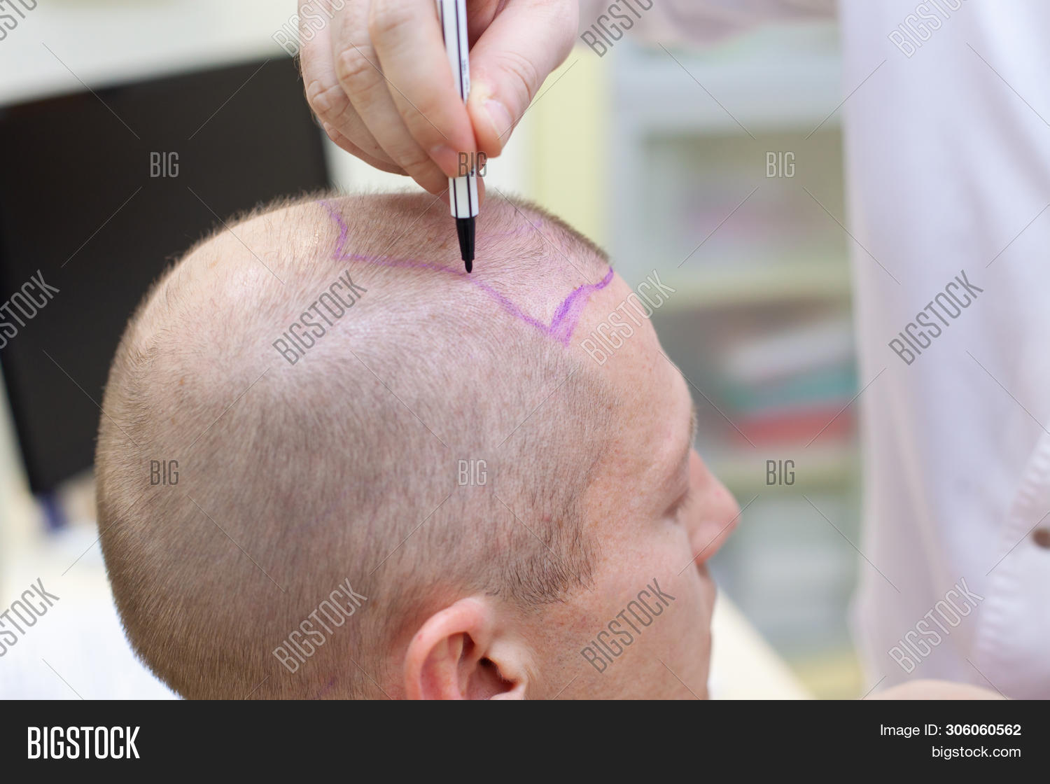 Baldness Treatment. Image &amp; Photo (Free Trial) | Bigstock