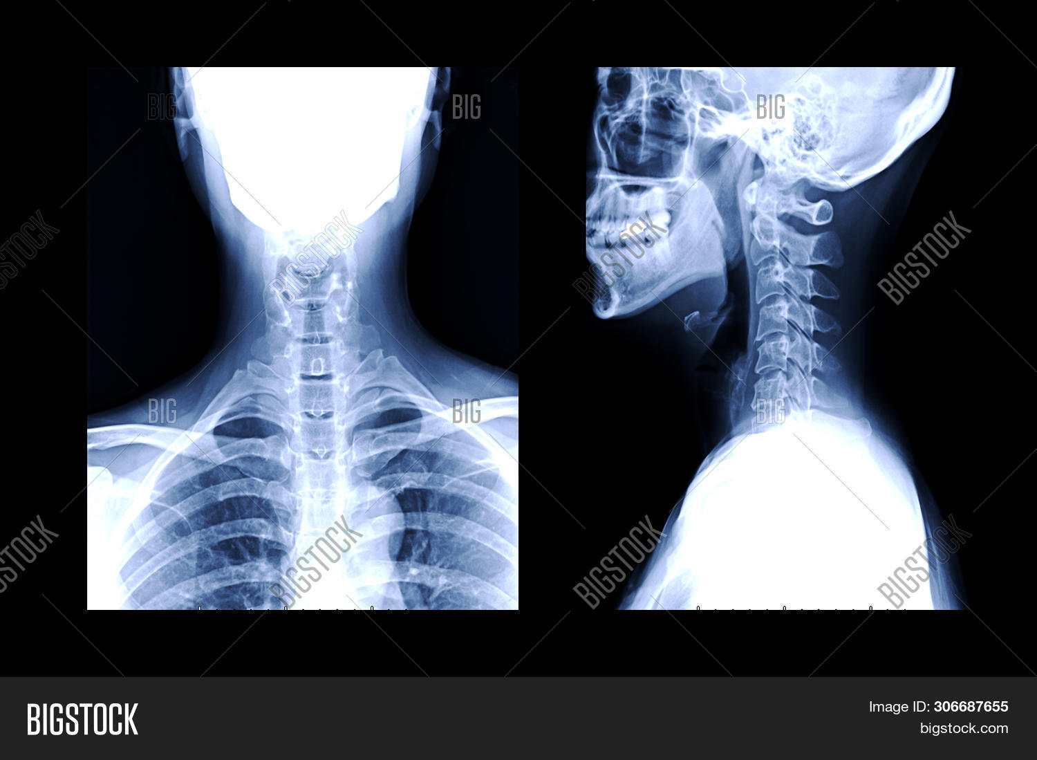 Xray Cspine Xray Image & Photo (Free Trial) Bigstock