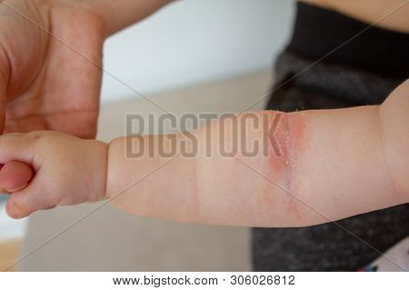 Close-up Of The Folds Of The Hand Of A Newborn Baby With Red Skin. Atopic Dermatitis Of Childrens Sk