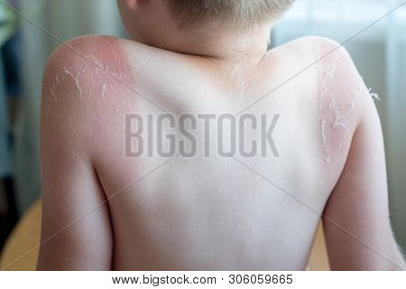 Sunburnt On Skin Around Knee Of Mans Left Leg, Isolated On White Background