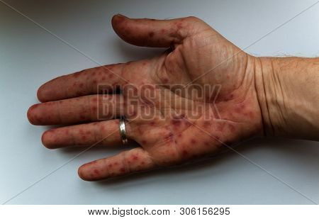 Hand Mouth Foot Ill Of An Adult