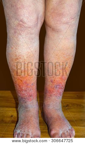 Close-up Of Skin With Varicose Veins On Senior Male Leg. Concept Of Dry Skin, Old Senior People, Var