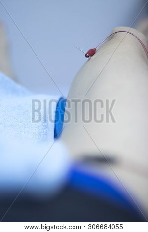 Epi Dry Needling Ultrasound Scan
