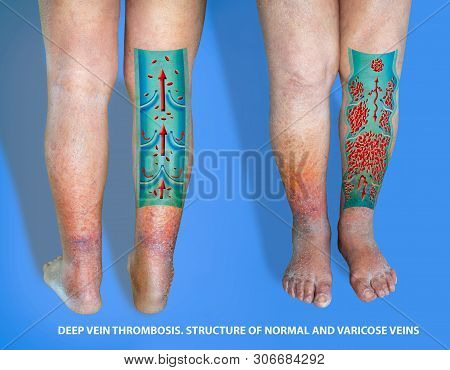 Close-up Of Skin With Varicose Veins On Senior Male Leg. Concept Of Dry Skin, Old Senior People, Var