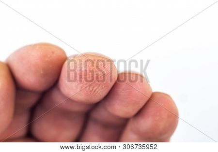 Advanced Stage Of Dyshidrosis On Fingers,cracked And Peeling Skin, White Background. Skin Allergy Pr