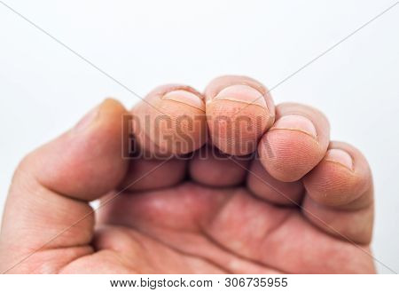 Advanced Stage Of Dyshidrosis On Fingers,cracked And Peeling Skin, White Background. Skin Allergy Pr
